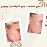 سرم لاکتيک اسید 5% و هیالورونیک اسید اودرینری (Ordinary) - Image 2